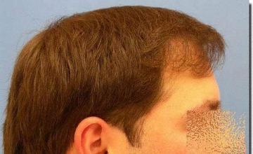 Hair restoration procedure results