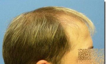 Hair restoration procedure results