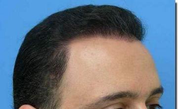 Hair restoration procedure results