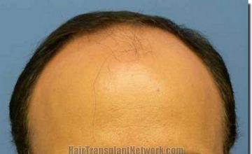 Hair restoration procedure results