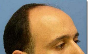 Hair restoration procedure results