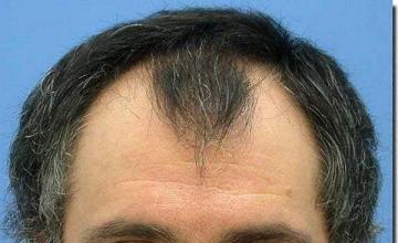 Hair restoration procedure results