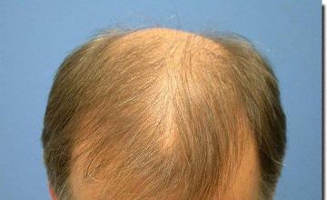 Hair restoration procedure results