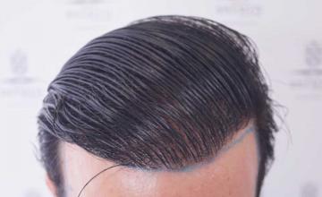 Frontal area before second surgery