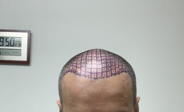 Hairline Mapped 