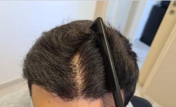 Comb through hairline