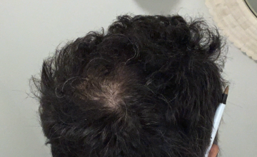 Crown at 7 months post-op 