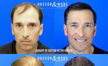 Front view - Before and after hair restoration procedure