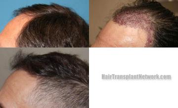 Left view -  before and after photos
