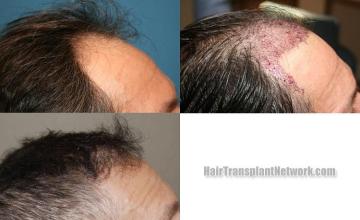 Hair transplantation procedure before and after results