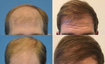 Before and after hair restoration procedure images