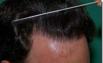 Hair restoration procedure results