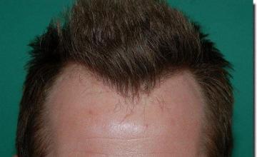 Hair restoration procedure results