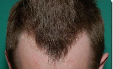 Hair restoration procedure results