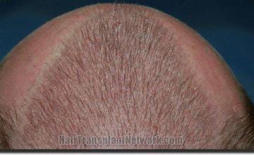 Hair restoration procedure results