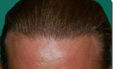 Hair restoration procedure results