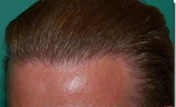 Hair restoration procedure results