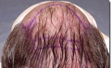 Hair restoration procedure results