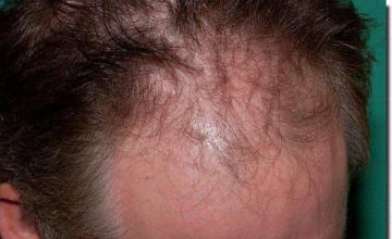 Hair restoration procedure results