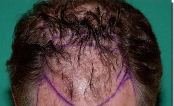 Hair restoration procedure results