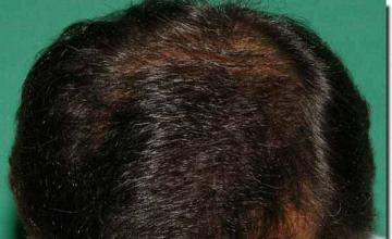 Hair restoration procedure results