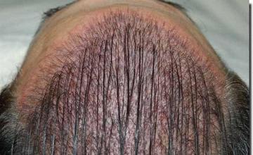 Hair restoration procedure results