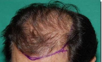 Hair restoration procedure results