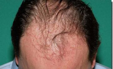 Hair restoration procedure results