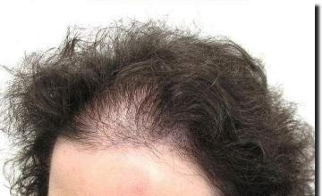 Hair restoration procedure results