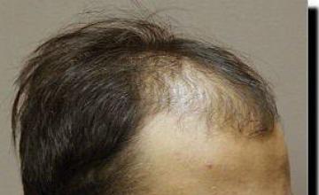 Hair restoration procedure results