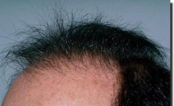 Hair restoration procedure results