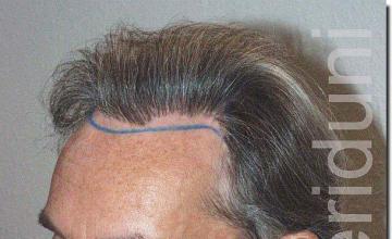 Hair restoration procedure results