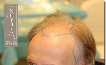 Hair restoration procedure results