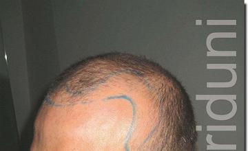 Hair restoration procedure results