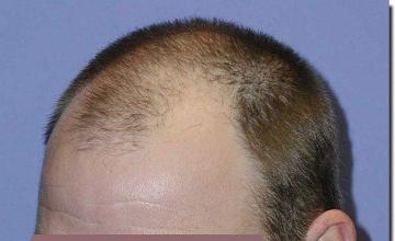 Hair restoration procedure results