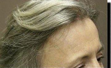 Hair restoration procedure results