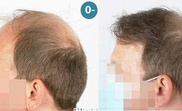 Left view before and after hair transplant surgery