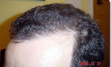 Hair restoration procedure results