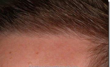 Hair restoration procedure results