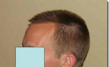 Hair restoration procedure results