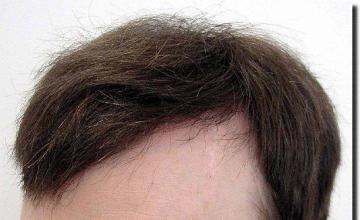 Hair restoration procedure results