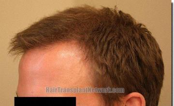 Hair restoration procedure results