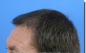 Hair restoration procedure results