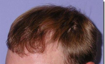 Hair restoration procedure results