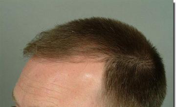 Hair restoration procedure results