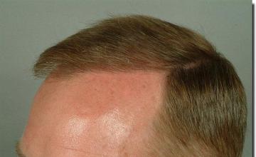 Hair restoration procedure results