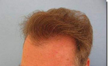 Hair restoration procedure results