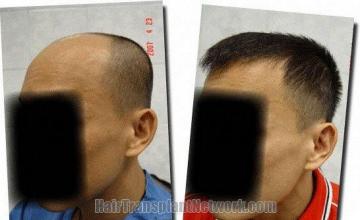 Hair restoration procedure results