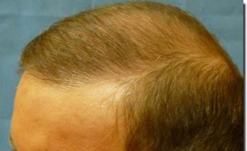 Hair restoration procedure results