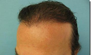 Hair restoration procedure results